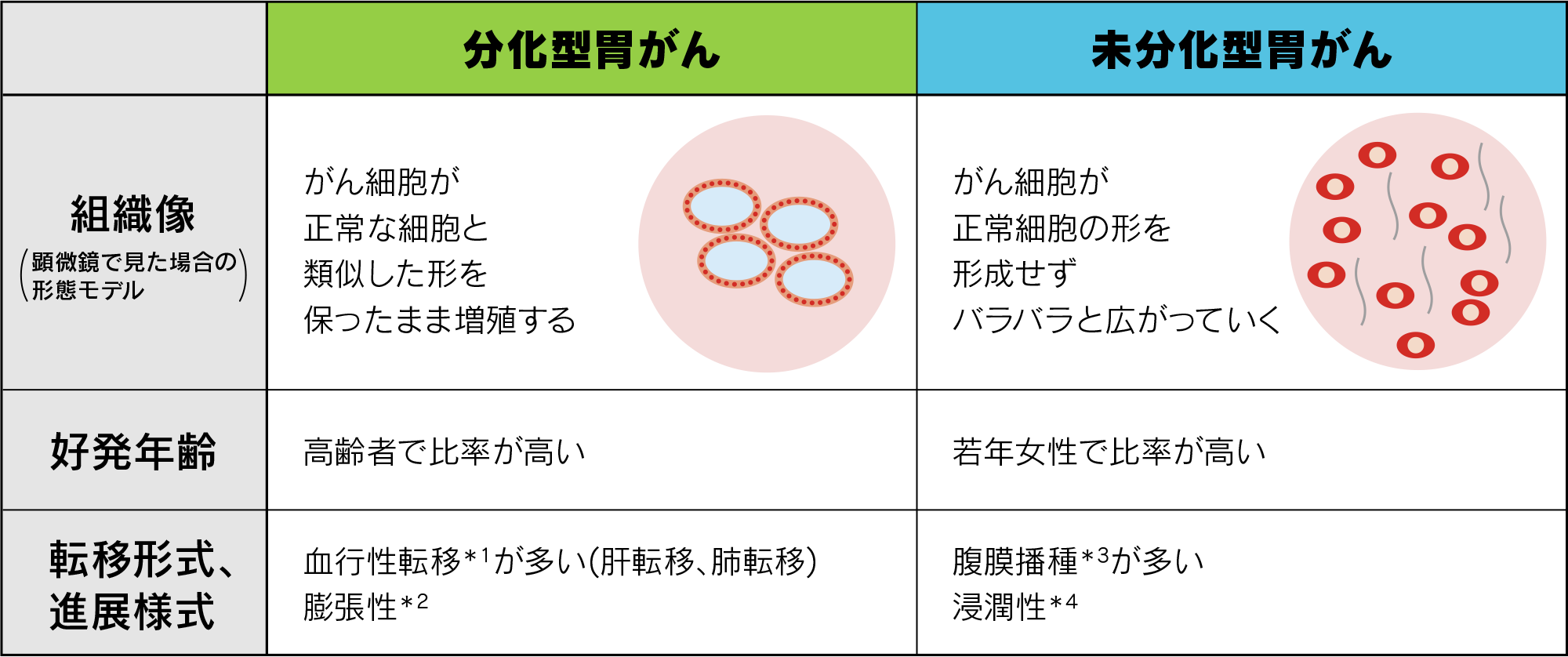 胃がんの病理組織型分類