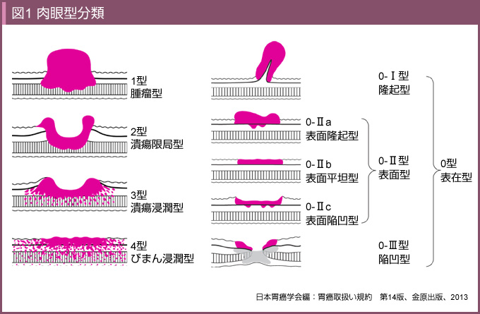 胃がんの肉眼的分類