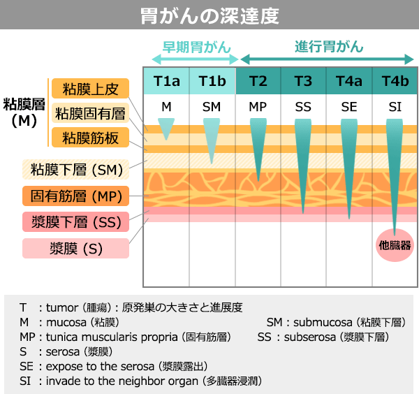 胃がんの（がんの深さ）での分類