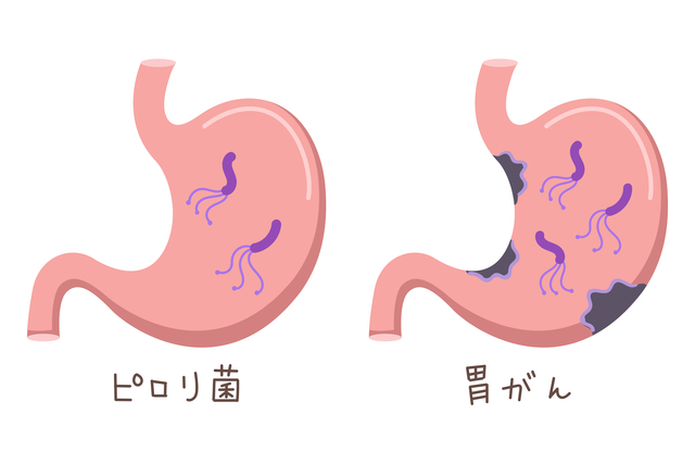 ピロリ菌と胃がんは密接な関係がある