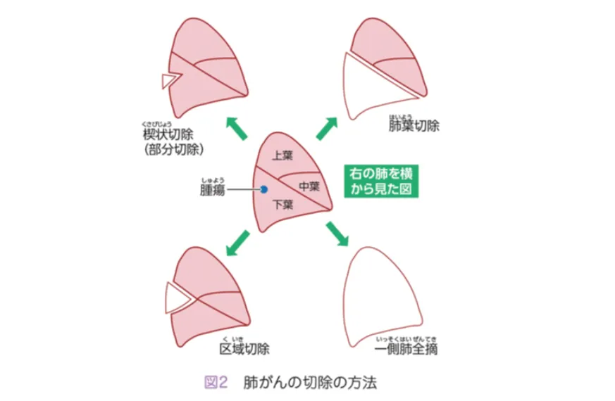 肺がんの切除の方法