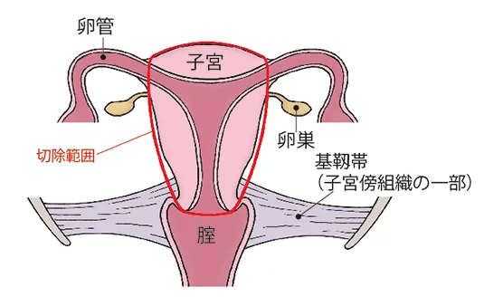 単純子宮全摘出術