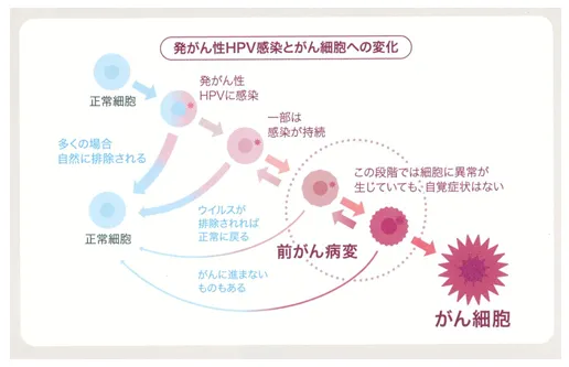 子宮頸がんの主な原因