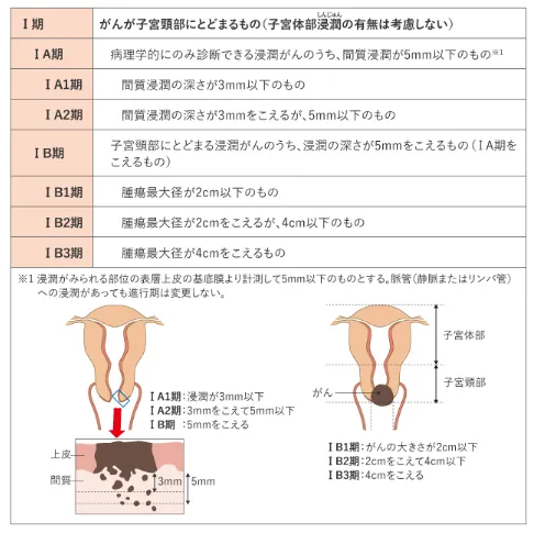 子宮頸がん初期（ステージ0・1）の症状と状態