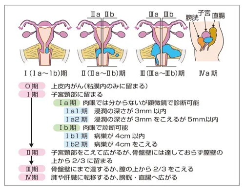 子宮頸がんのステージ分類