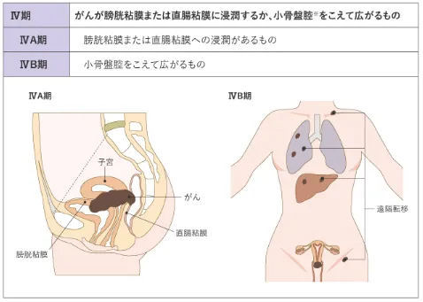 子宮頸がんステージ4の状態と症状