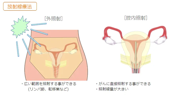 放射線療法