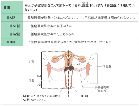 子宮頸がんステージ2・3の状態