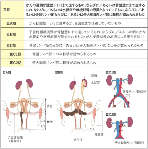 子宮頸がんステージ2・3の状態