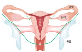 広汎子宮全摘出手術