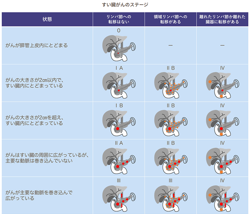 膵臓がんステージ2・3の状態や症状