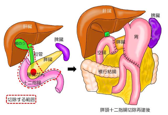 膵頭十二指腸切除術