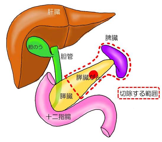 膵体尾部切除