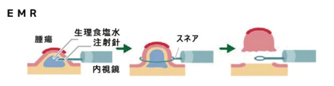 内視鏡的粘膜切除術（以下：EMR）