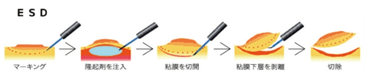 内視鏡的粘膜下層剥離術（ESD）