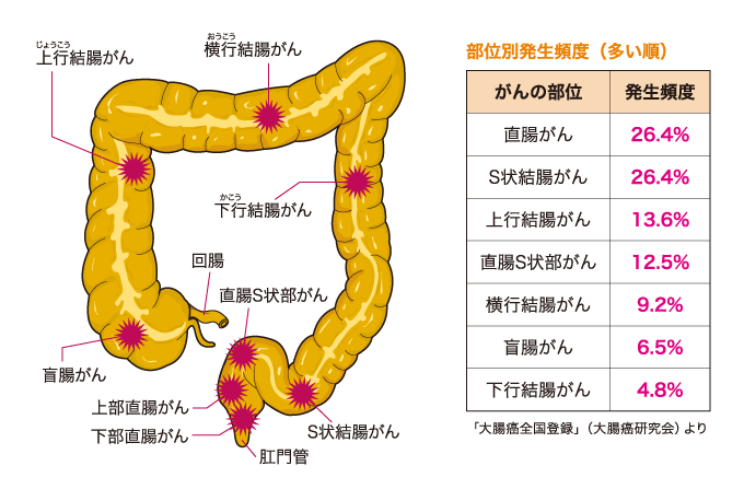 大腸がんステージ2・3の治療法