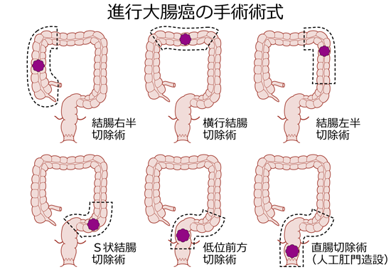 結腸がんの手術