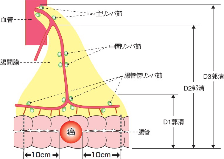 リンパ節郭清の範囲について