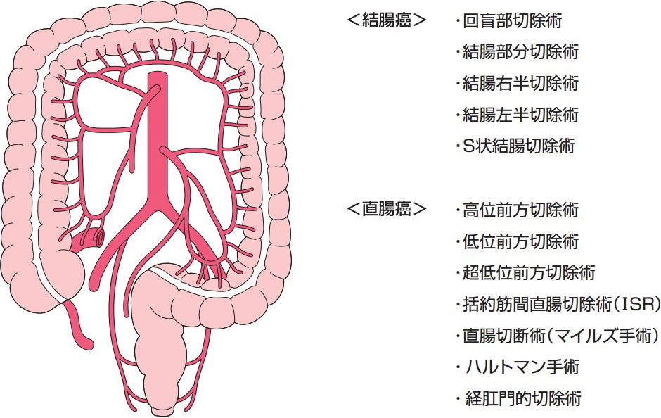 直腸がんの手術