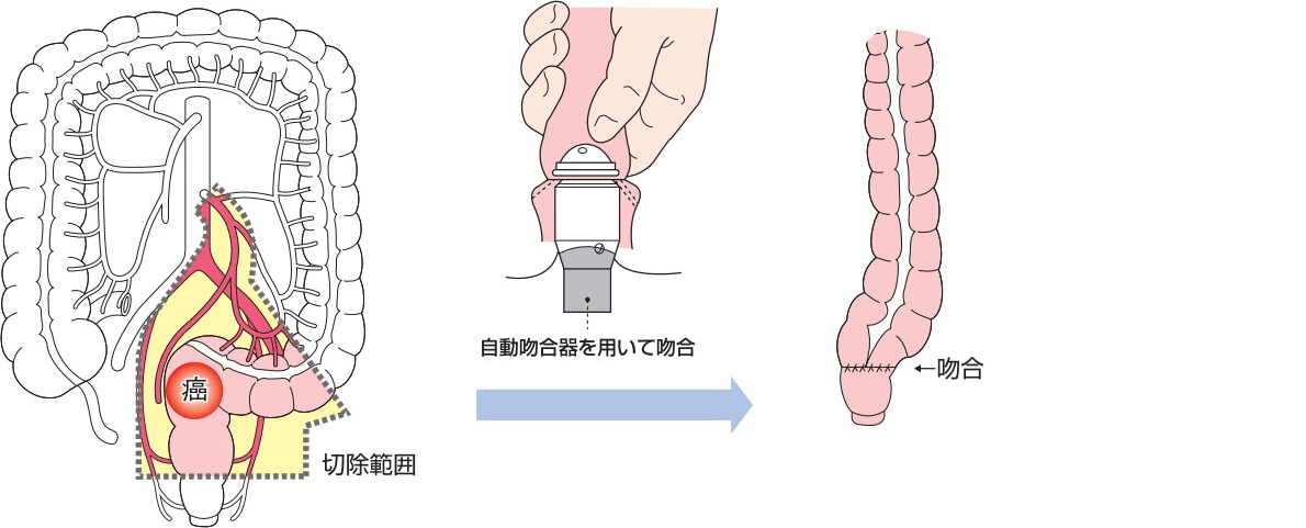 排便の機能を温存する手術