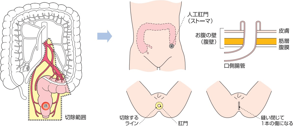 人工肛門を増設する手術