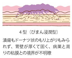 スキルス胃がんは「4型」「LP型」「未分化型」とも呼ばれている1