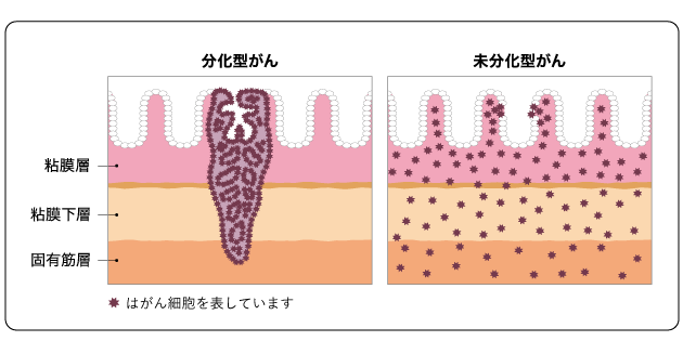 スキルス胃がんは「4型」「LP型」「未分化型」とも呼ばれている2