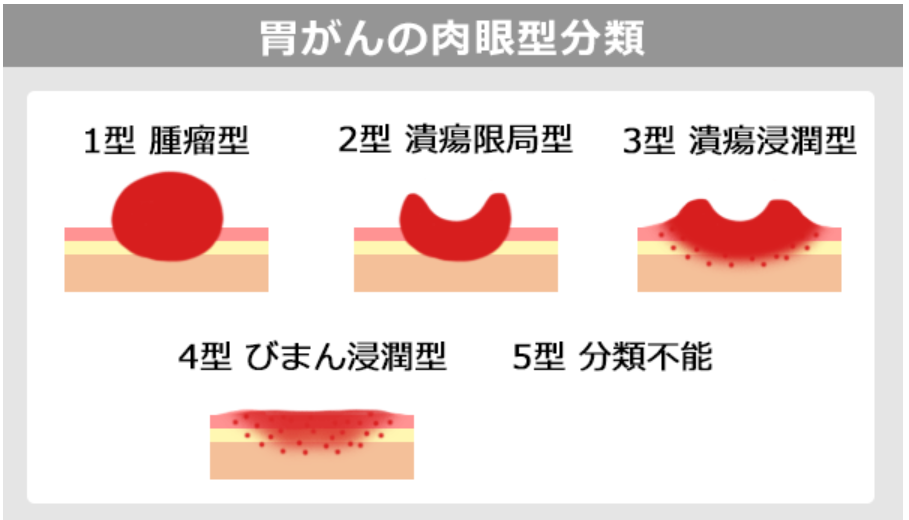 スキルス胃がんの分類