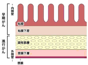 一般的な胃がんとの進行速度の違い