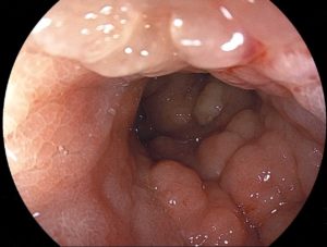 スキルス胃がんの検査方法3