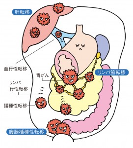 転移とは