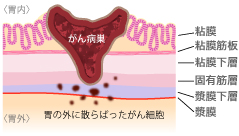 腹膜播種性