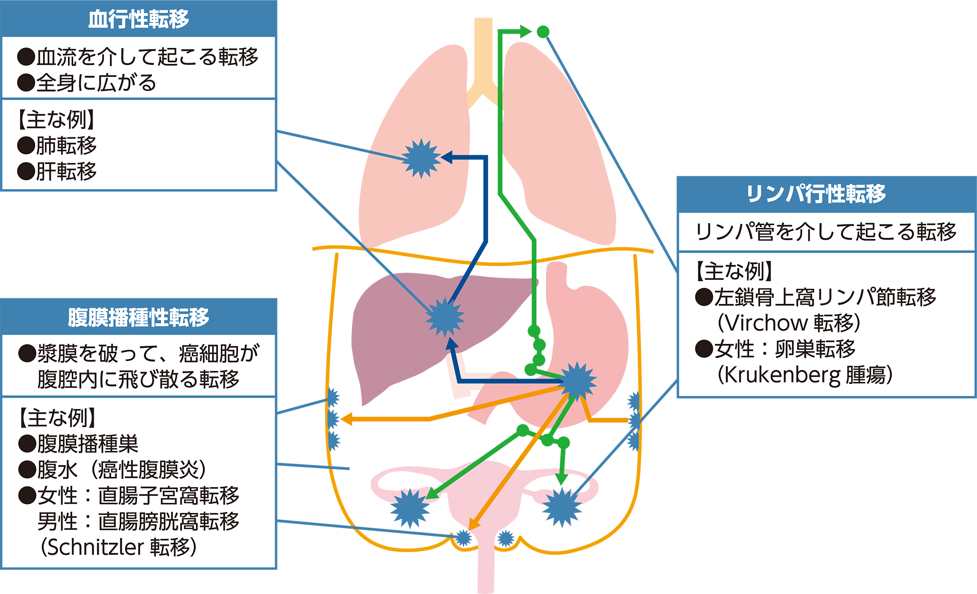 胃がんはどこに転移するのか