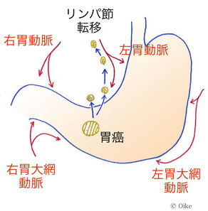 リンパ節転移