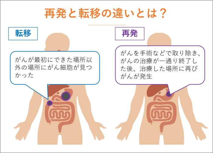 胃がんの再発と転移