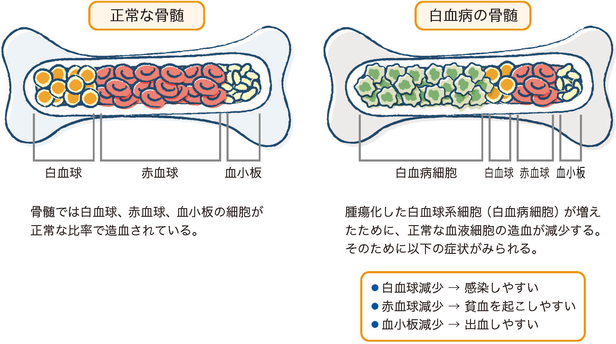 白血病とは