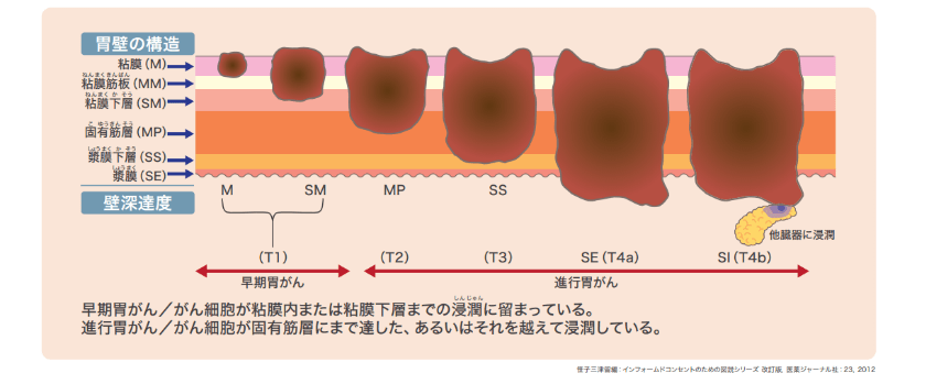 深達度分類