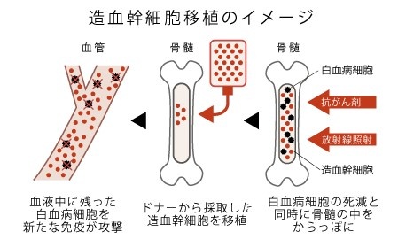 骨髄移植による治療