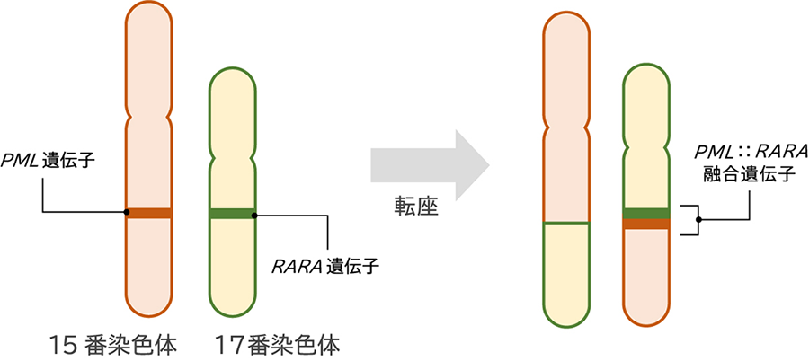 急性前骨髄球性白血病（APL）