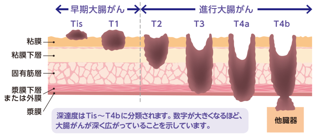 進行した大腸がんとは