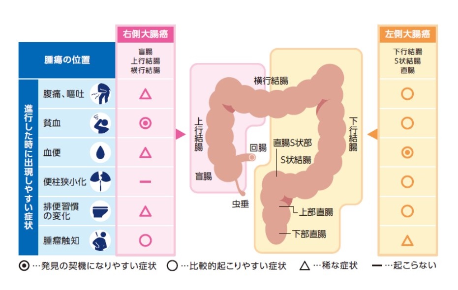 大腸がんが生じる場所による症状の違い