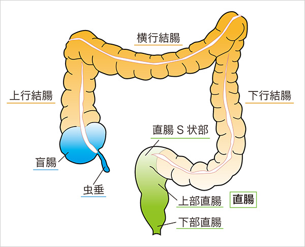 直腸がんとは