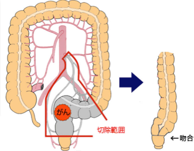 ①肛門機能温存術