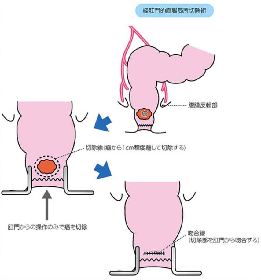 ②局所切除術