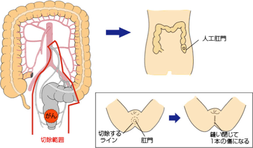 直腸切断術（マイルズ手術）