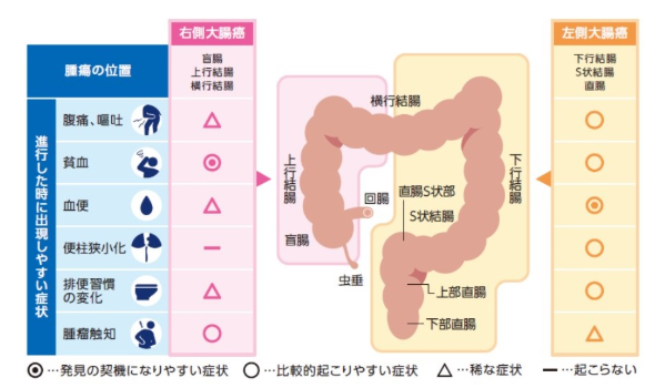 右側の盲腸・上行結腸・横行結腸までのがんは自覚症状が起こりにくい