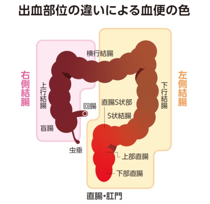 大腸がんと便の異常