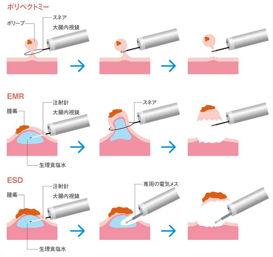 内視鏡治療