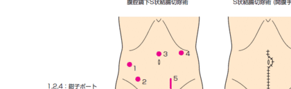 腹腔鏡手術