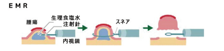 ②EMR（内視鏡的粘膜切除術）